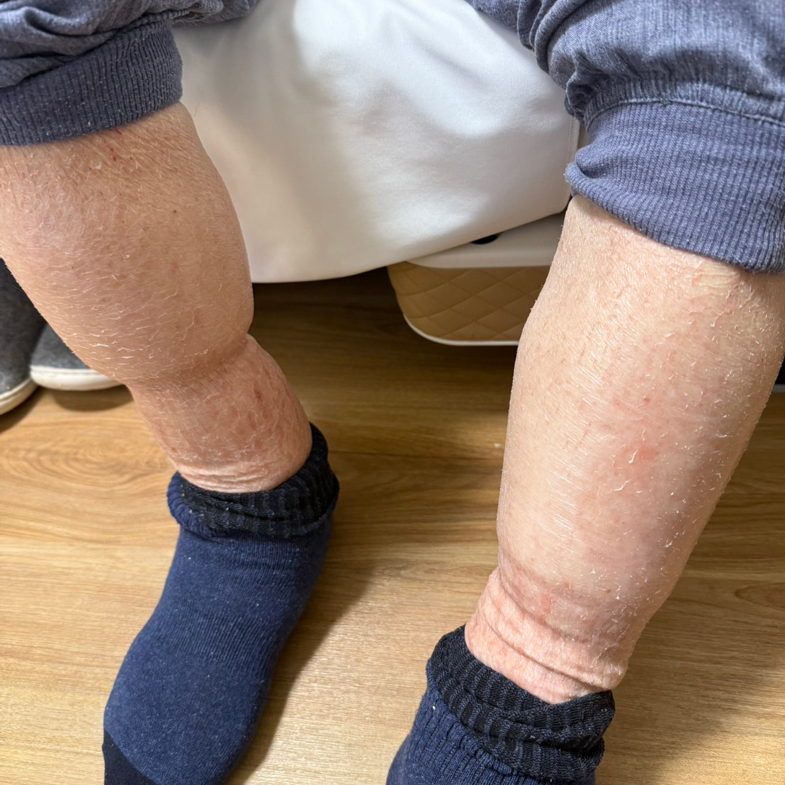 施術前の状態（80代男性）